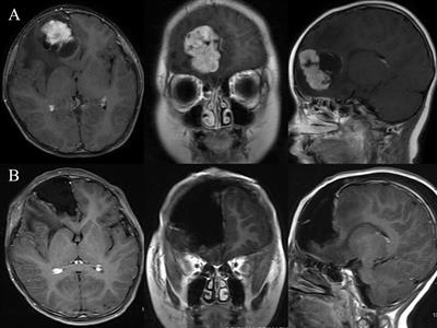 Choroid Plexus Carcinomas With TP53 Germline Mutations: Management and Outcome